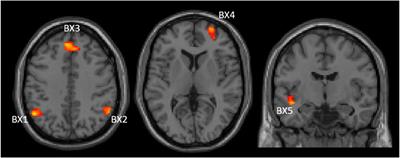 Categorical and dimensional aspects of stimulant medication effects in adult patients with ADHD and healthy controls